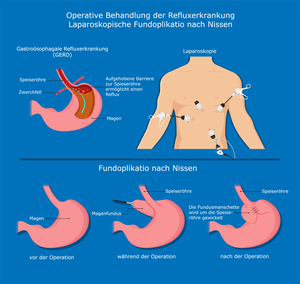 Fundoplicatio